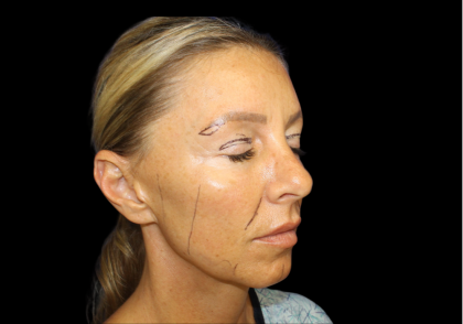 Facelift Before & After Patient #479
