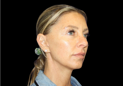 Facelift Before & After Patient #479
