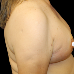 Breast Lift Before & After Patient #481