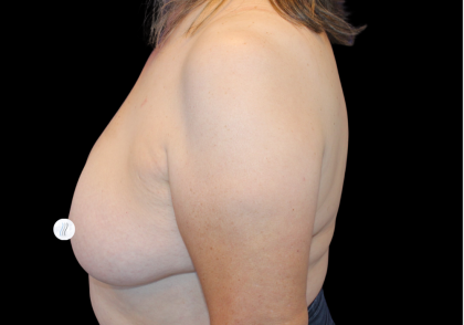 Breast Lift Before & After Patient #481