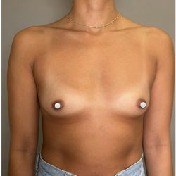 Breast Augmentation Before & After Patient #547