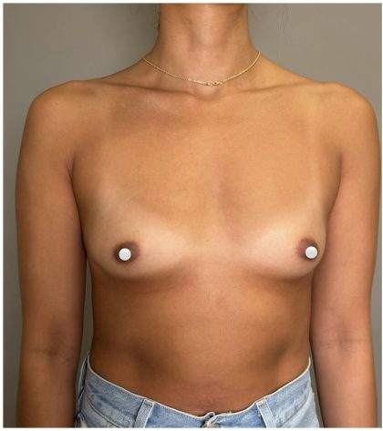 Breast Augmentation Before & After Patient #547