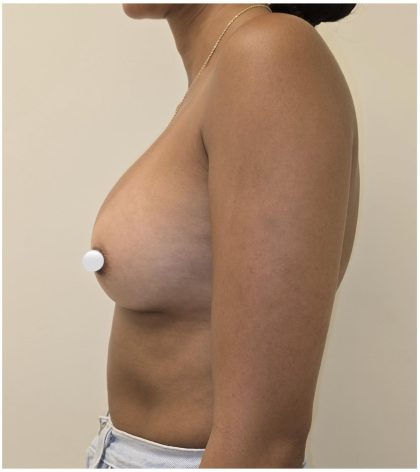 Breast Augmentation Before & After Patient #547