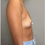 Breast Augmentation Before & After Patient #547
