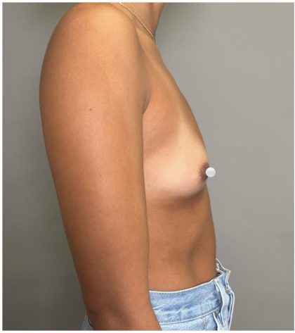 Breast Augmentation Before & After Patient #547