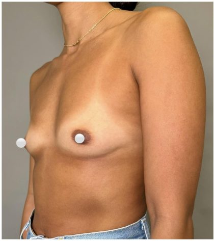 Breast Augmentation Before & After Patient #547