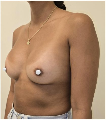 Breast Augmentation Before & After Patient #547