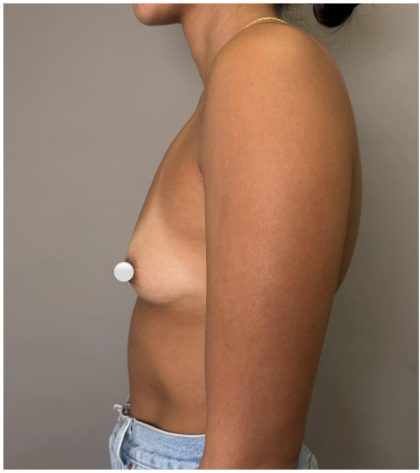 Breast Augmentation Before & After Patient #547