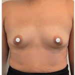 Breast Augmentation Before & After Patient #548