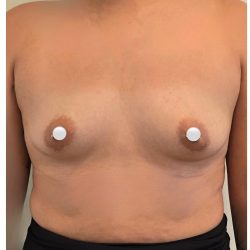 Breast Augmentation Before & After Patient #548