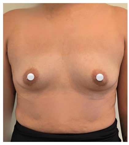 Breast Augmentation Before & After Patient #548