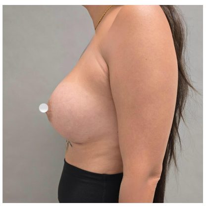 Breast Augmentation Before & After Patient #548