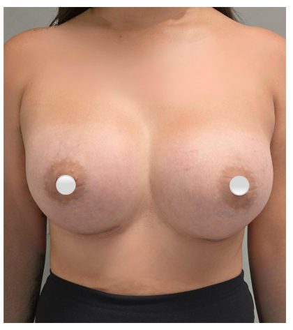 Breast Augmentation Before & After Patient #548