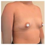 Breast Augmentation Before & After Patient #548