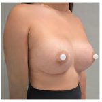 Breast Augmentation Before & After Patient #548