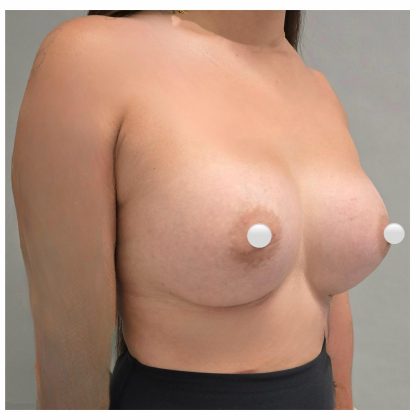 Breast Augmentation Before & After Patient #548