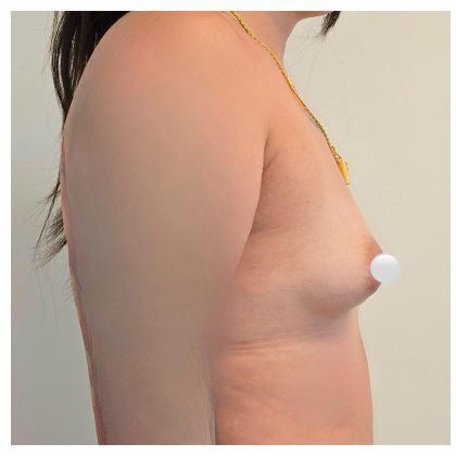 Breast Augmentation Before & After Patient #548