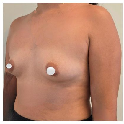 Breast Augmentation Before & After Patient #548