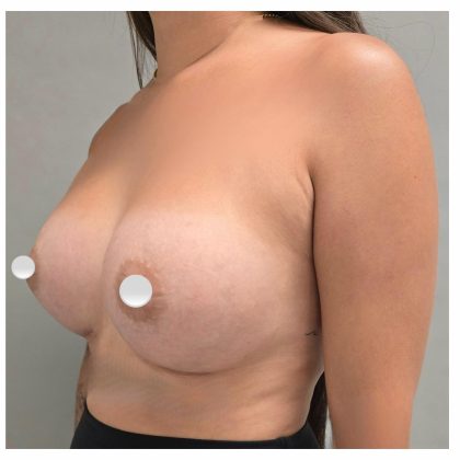 Breast Augmentation Before & After Patient #548