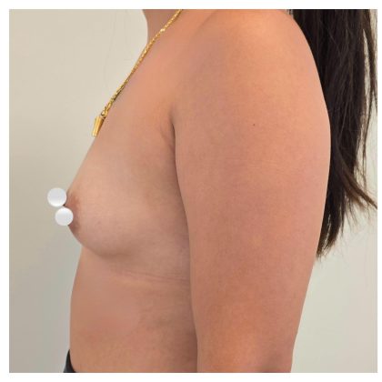 Breast Augmentation Before & After Patient #548