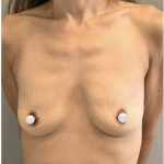 Breast Augmentation Before & After Patient #549