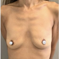 Breast Augmentation Before & After Patient #549