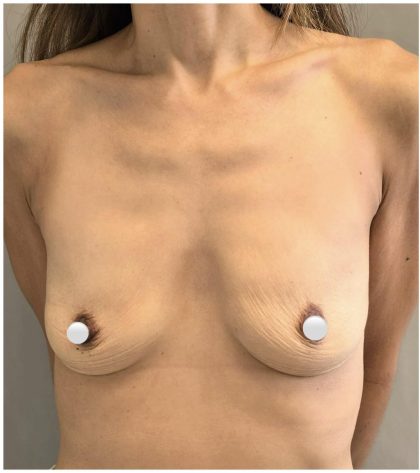 Breast Augmentation Before & After Patient #549