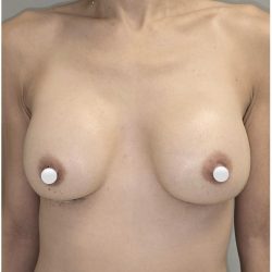 Breast Augmentation Before & After Patient #549