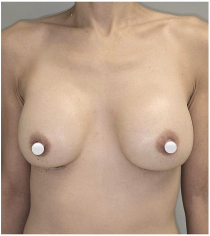 Breast Augmentation Before & After Patient #549