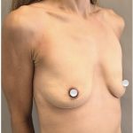 Breast Augmentation Before & After Patient #549