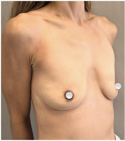 Breast Augmentation Before & After Patient #549