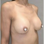 Breast Augmentation Before & After Patient #549