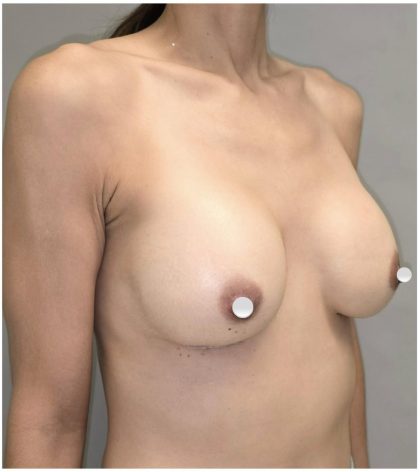 Breast Augmentation Before & After Patient #549