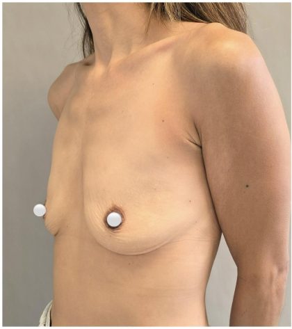 Breast Augmentation Before & After Patient #549