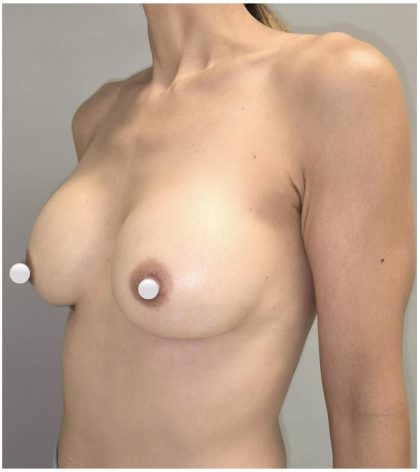 Breast Augmentation Before & After Patient #549