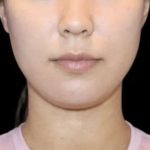 Neck Liposuction Before & After Patient #617