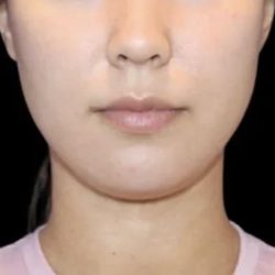Neck Liposuction Before & After Patient #617
