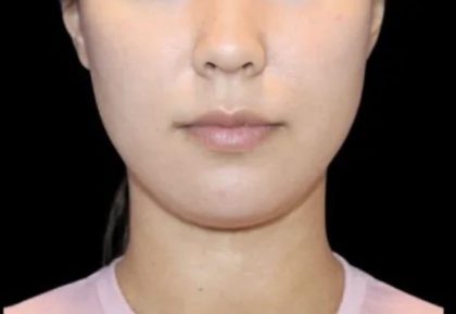 Neck Liposuction Before & After Patient #617