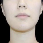 Neck Liposuction Before & After Patient #617