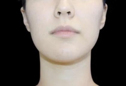 Neck Liposuction Before & After Patient #617