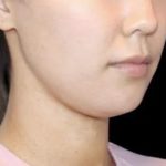 Neck Liposuction Before & After Patient #617