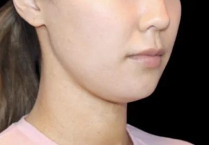 Neck Liposuction Before & After Patient #617