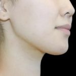 Neck Liposuction Before & After Patient #617