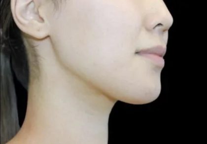 Neck Liposuction Before & After Patient #617
