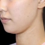 Neck Liposuction Before & After Patient #617