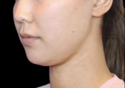 Neck Liposuction Before & After Patient #617