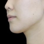 Neck Liposuction Before & After Patient #617