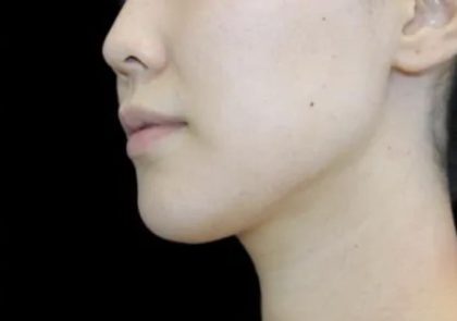 Neck Liposuction Before & After Patient #617