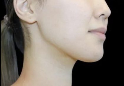 Neck Liposuction Before & After Patient #617