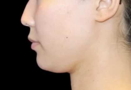 Neck Liposuction Before & After Patient #617